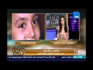 المعهد القومي لعلوم الليزر يوضح حقيقة حالة الطفلة نوسة .. قد تكون مصابة بسرطان جلدي