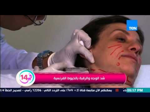 قمر 14 - د/هيثم رزق يتحدث عن الخيوط الفرنسية لشد الرقبة والوجه بالتطبيق على حالة داليا محمد