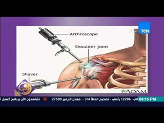 عسل أبيض - بالصور .. تعرف على كيف تتم جراحات "الكتف والكاحل" بالمناظير من د/فريد سمير