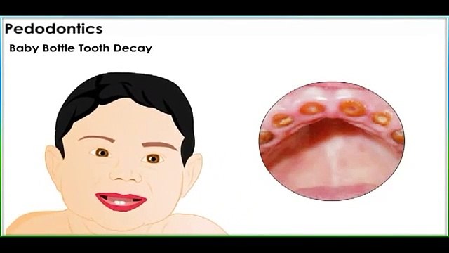 Baby bottle Tooth Decay- Dental Sphere