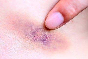 Der Ursprung der blauen Flecken