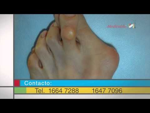 ¿Cuáles son los síntomas de un juanete?