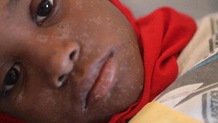 Kanyaró elleni azonnali oltást sürget a WHO