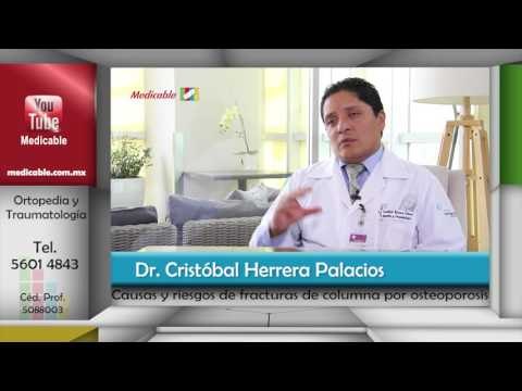 003 CAUSAS DE FRACTURASDE COLUMNA POR OSTEOPOROSIS Y QUIEN ESTA EN RIESGO