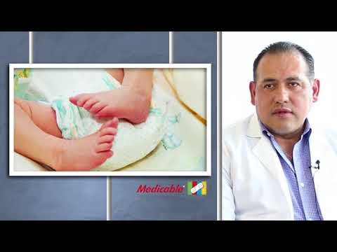 DISPLASIA CONGÉNITA DE CADERA EN NIÑOS