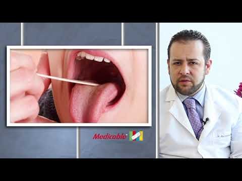 HIPERTROFIA DE AMÍGDALAS Y ADENOIDES EN NIÑOS