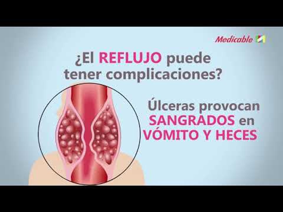 COMPLICACIONES DEL REFLUJO