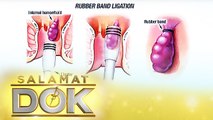 Salamat Dok: Dr. Fuentes discusses the treatment and surgical procedure for hemorrhoids or almuranas