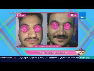 كلام البنات - كيف نتجنب فشل عمليات تجميل الأنف؟ - فقرة كاملة