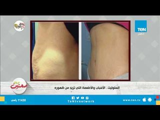 أسباب ظهور السلوليت والأطعمة التي تزيد من ظهوره