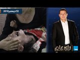 رأي عام| باحث شرعي بمشيخة الأزهر: الخلخال والبيرسينج حلال.. واول دعوة قضائية بسبب ختان البنات