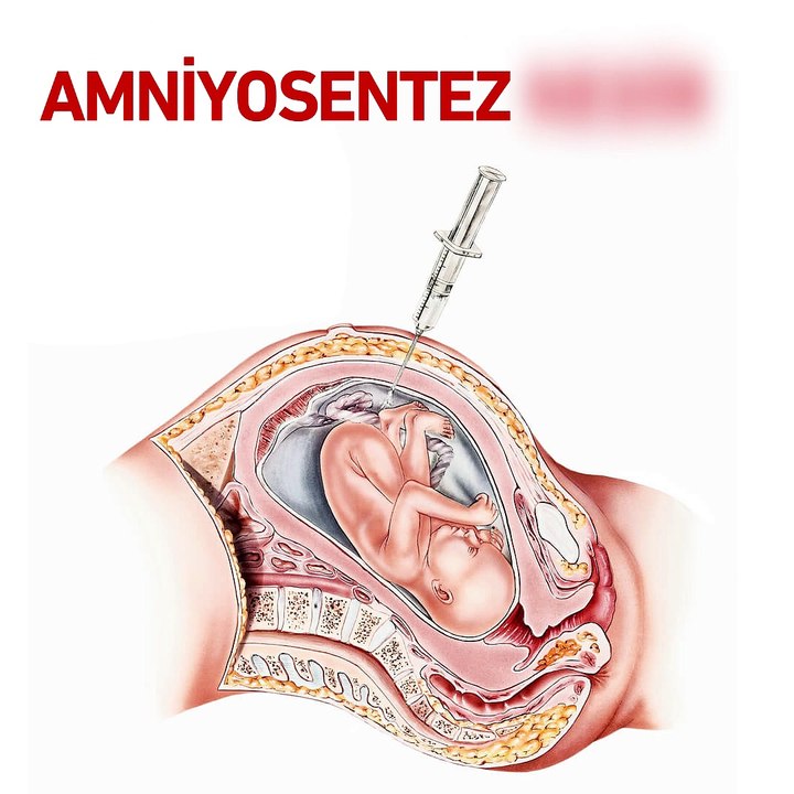 Amniyosentez nedir?