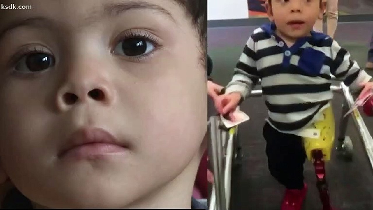 Parents Ask Thief Who Stole Toddler's $10,000 Prosthetic Leg To Give It Back