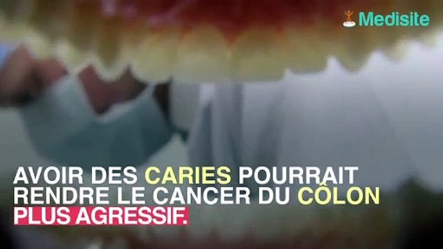 La bactérie à l'origine des caries responsable de cancers du côlon agressifs
