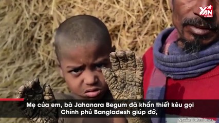 Phép màu kỳ diệu đến với cậu bé “hóa đá” vì mắc bệnh lạ hiếm gặp