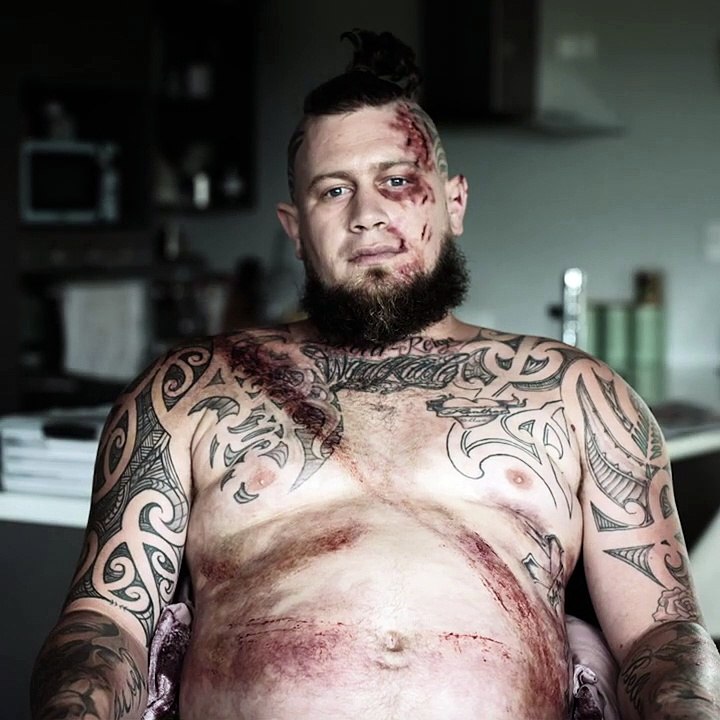 Ils montrent la marque laissée par la ceinture de sécurité après leur accident de voiture pour montrer toute l'importance de celle-ci