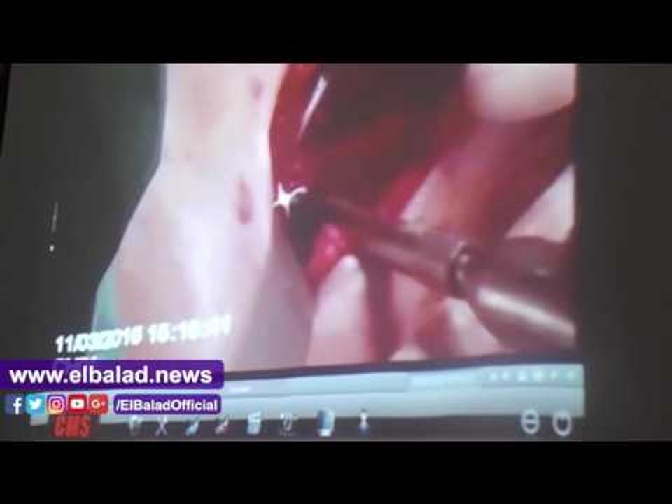 صدى البلد |  لاول مرة عمليات جراحية "بث مباشر" فى احد الندوات الطبية بطب المنصورة