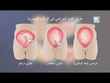 Alyaa Gad - C-Section الولادة القيصرية