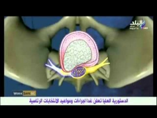هام كيفية حدوث الانزلاق الغضروفى