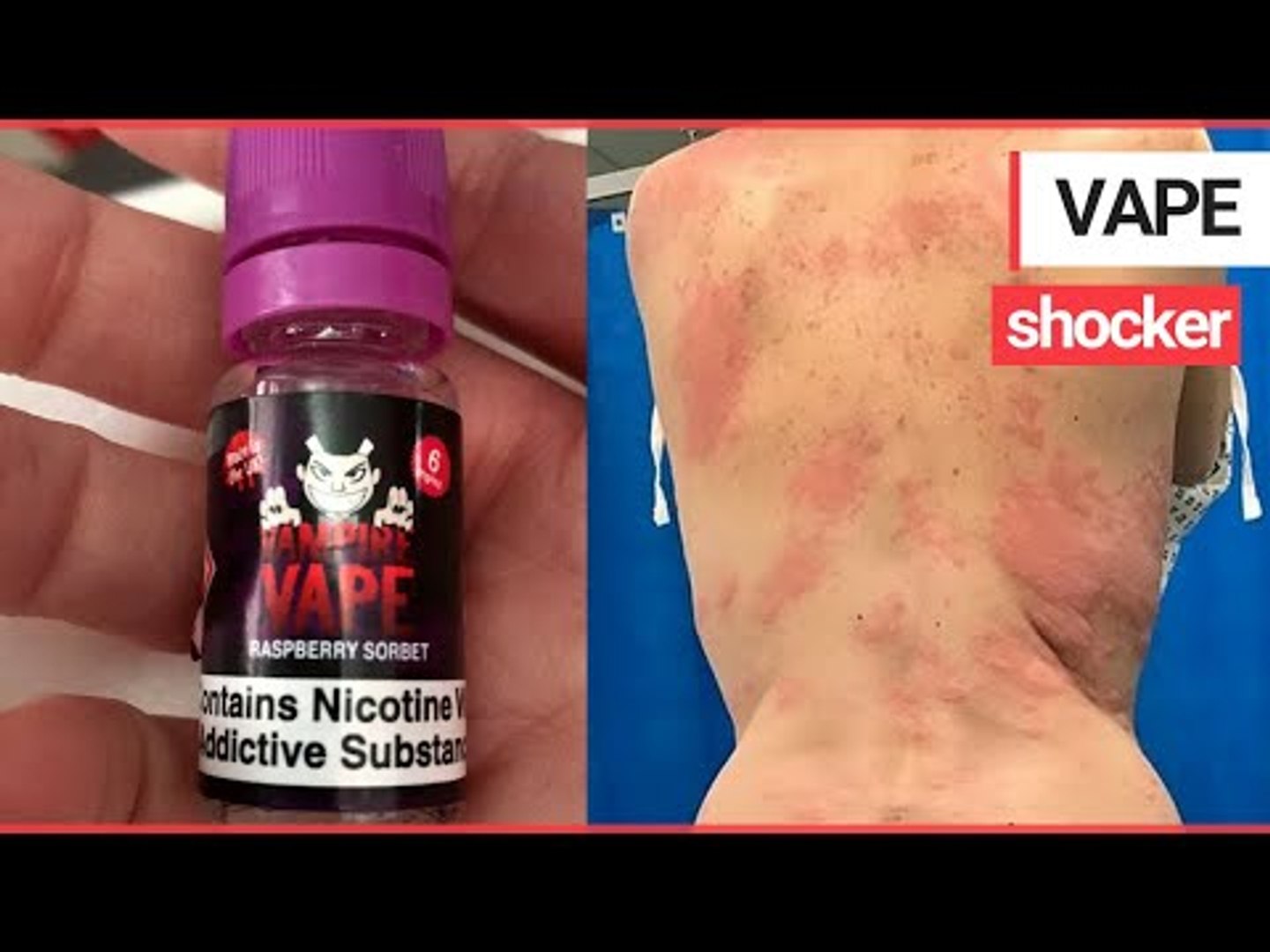 A mum was left with painful burn-like rashes after a serious allergic  reaction to VAPING | SWNS TV