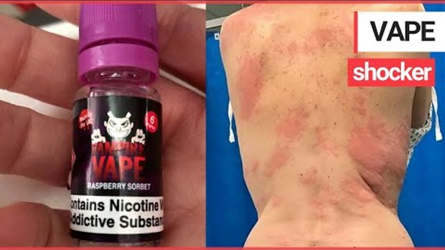 A mum was left with painful burn-like rashes after a serious allergic reaction to VAPING | SWNS TV