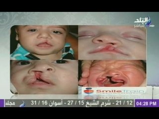 شاهد...أسباب وطرق علاج الشفة الارنبية وشق الحنك | هات م الآخر