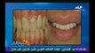 بالفيديو.. تعرف على هوليود سمايل طريقة علاج حديثة في عالم تجميل الأسنان