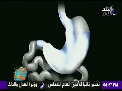 كل ما تريد أن تعرفه عن عملية تكميم المعدة - تدبيس المعدة