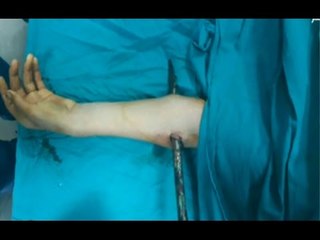 مع شوبير | شاهد المأساة التي تعرض لها طفل سيخ الحديد داخل مستشفى كفر الشيخ (+18)