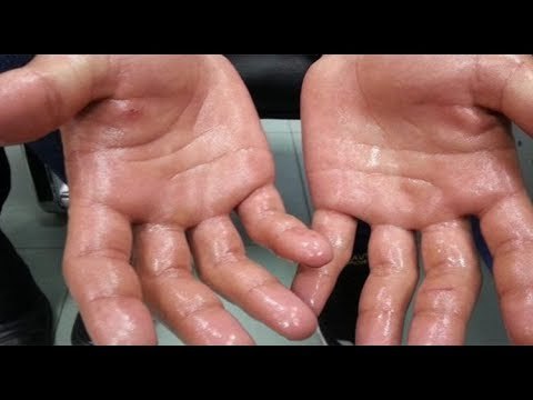 صدى البلد | هذا هو الحل الوحيد للتخلص من تعرق اليدين ... تعرف على الطريقه