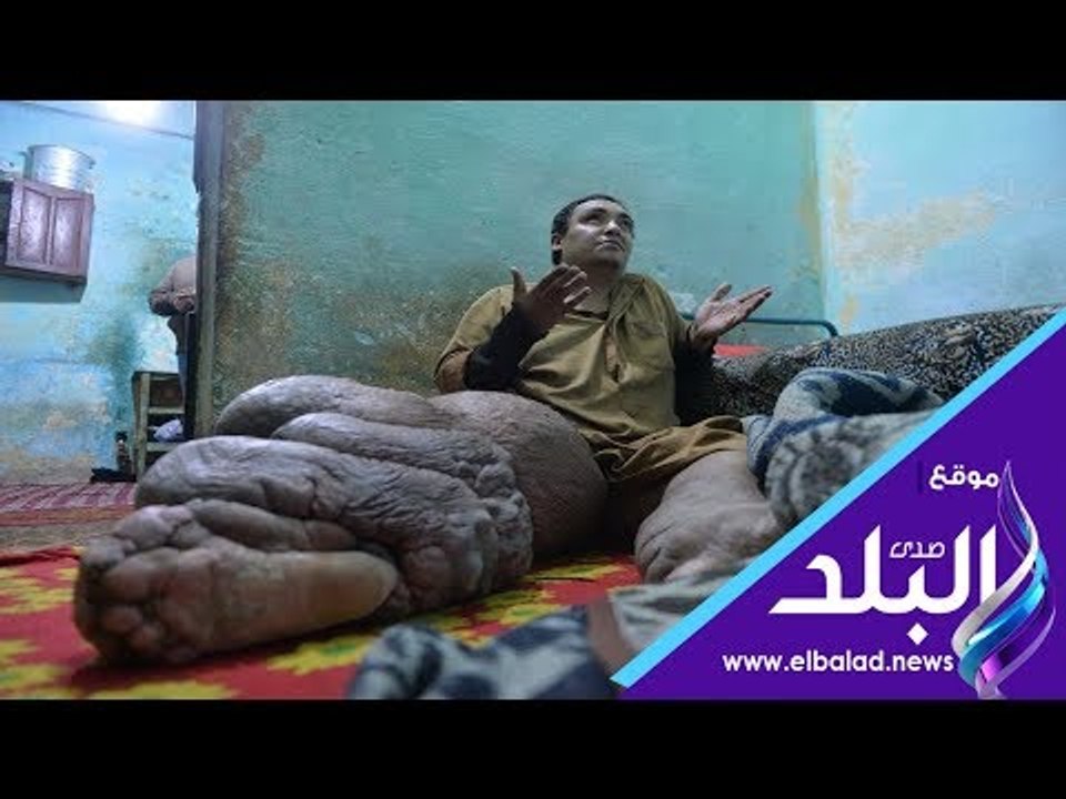 صدى البلد | داء الفيل يدمر حياة عم محمود .. "رجلى بتتقطع كل يوم"