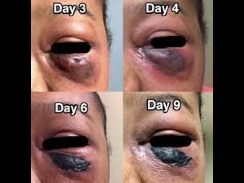 صدى البلد | تعرف على التقنيات الحديثة التى تضمن عدم رفض الجسم للقرنية الجديدة