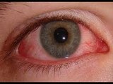 صدى البلد |  طبيب عيون يكشف العلاج الأمثل لمرضى حساسية العين