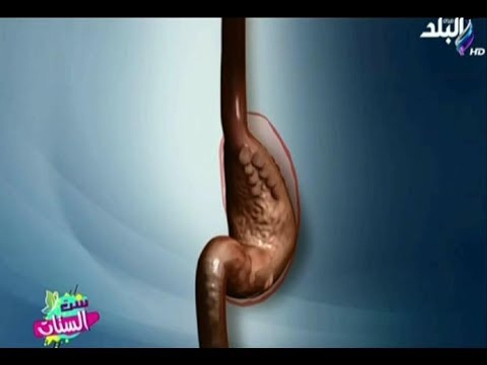 تعرف أحدث اساليب التخسيس وحرق الدهون بدون جراحة