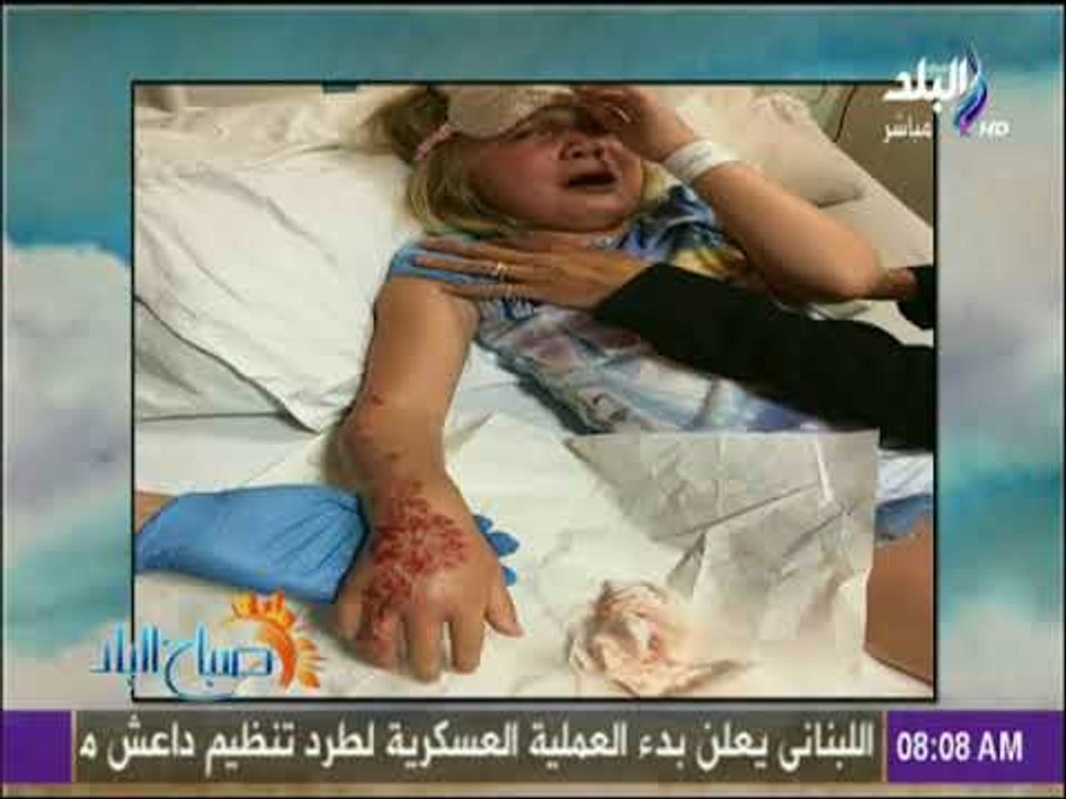 صباح البلد - شاهد الجحيم الذي سببته الحِنة المصرية "السامة" مع طفلة بريطانية