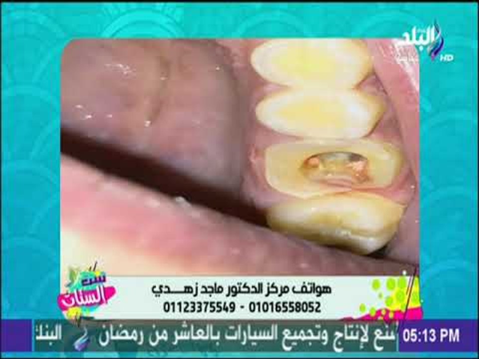ست الستات - أحدث طرق علاج جذور وعصب الأسنان بدون ألم