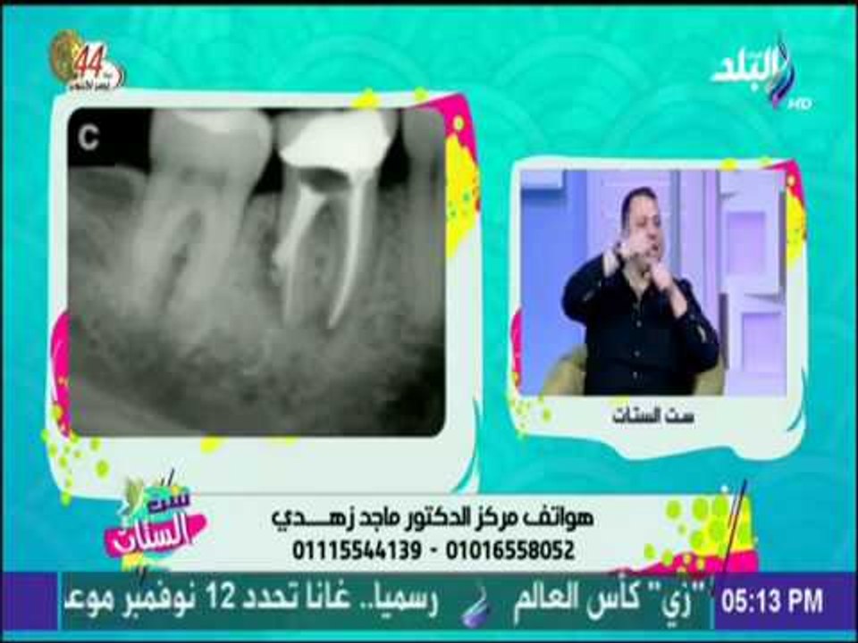 ست الستات - تعرف علي أفضل طرق علاج الاسنان والمحافظة عليها بعد علاج الجذور مع الدكتور ماجد زهدي