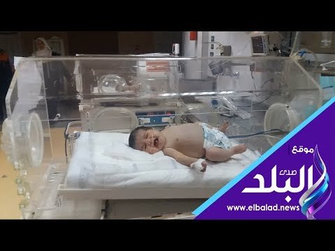صدى البلد | معجزة تحدث مرة في المليون رضيعة من أسيوط عمرها 5 أيام حامل في جنين آخر