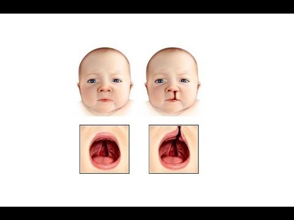 صدي البلد | 3 أنواع الشفة الأرنبية عند الأطفال وهذه طرق علاجها