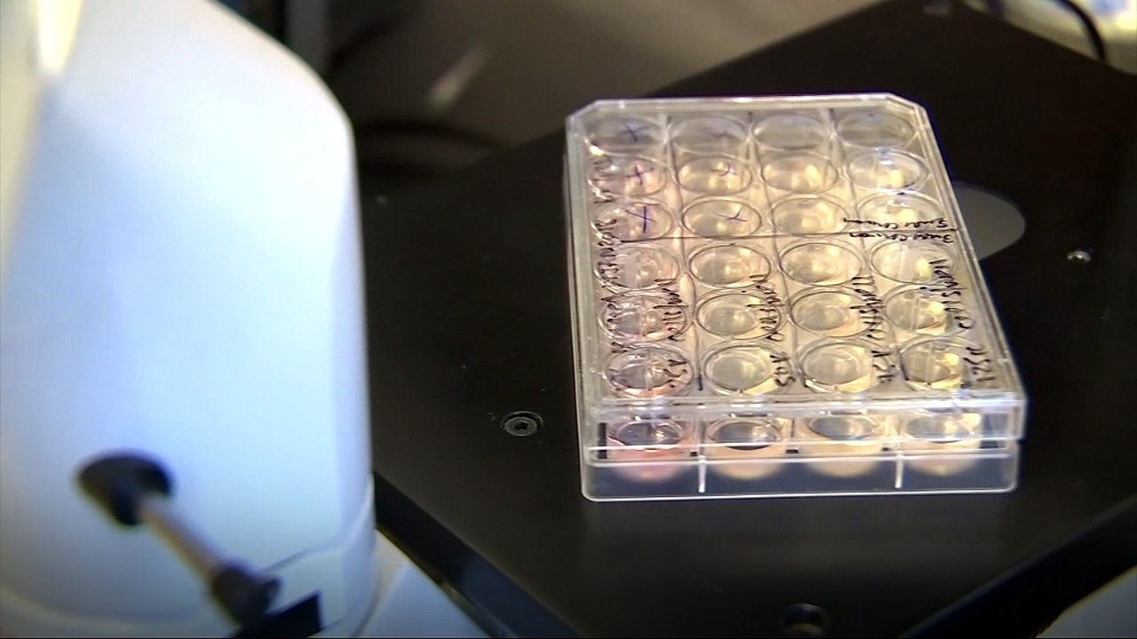 Patients and researchers optimistic about second H.I.V. cure using stem-cell transplant