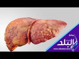 صدي البلد | تعرف على انواع سرطان الكبد