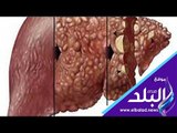 صدي البلد | للاكتشاف المبكر .. إليك أعراض سرطان الكبد العامة