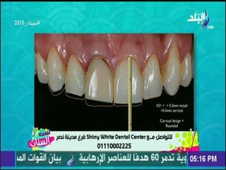 ست الستات - شاهد أحد الطرق لتجميل وتبيض الأسنان ما هو فينير الأسنان