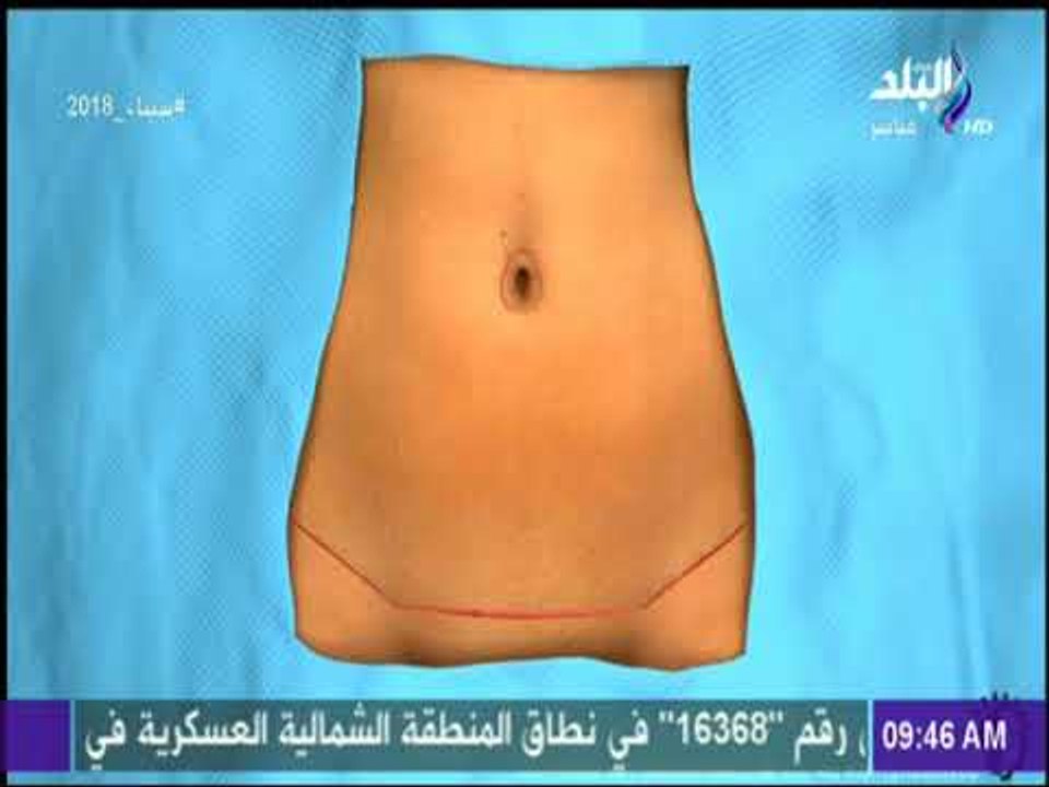 صباح البلد - عملية شفط دهون البطن -  الفوائد والمخاطر مع د.أشرف سمعان