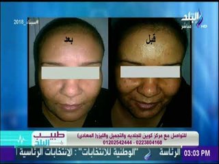 الدكتورة ميرال كمال ونصيحة هامة لكل عروسة للتخلص من حب الشباب قبل الزواج