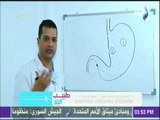طبيب البلد - شرح نظري لأخطاء عملية تكميم المعدة - د. محمد الفولي