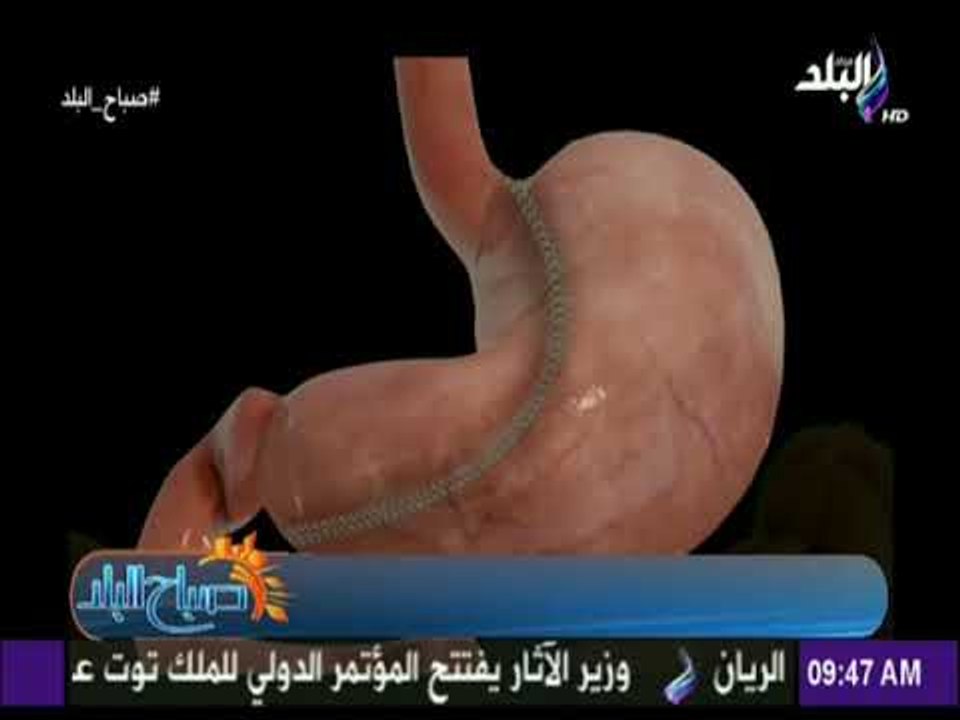 صباح البلد - الجديد فى عمليات شفط الدهون وإنقاص الوزن مع الدكتور كريم صبري