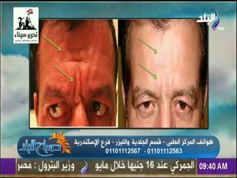 صباح البلد - تعرف على أسباب ظهور تجاعيد و تصبغات الوجه وكيفية القضاء عليها