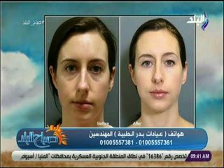 صباح البلد -  افضل طرق لعلاج البشرة - د. ياسمين طارق