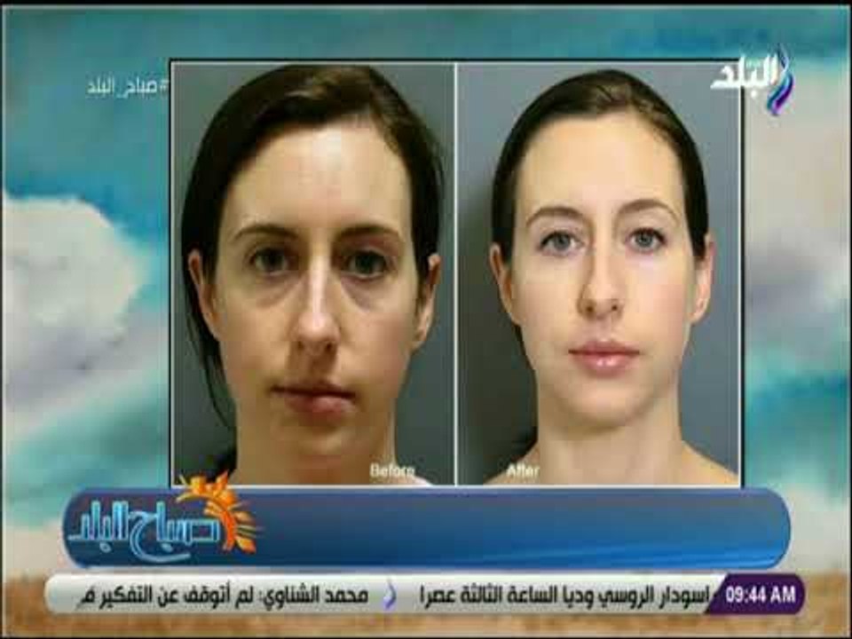 صباح البلد - افضل طرق للحصول على بشرة نضرة مع الدكتور ياسمين طارق